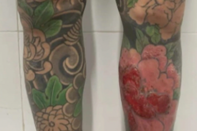 Mực xăm chứa nhiều thành phần hóa học, kim loại nặng có khả năng gây kích ứng nghiêm trọng